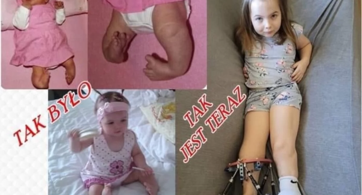 Pomoc charytatywna, letnia Lenka Cholewa walczy sprawność czterech etapach leczenia potrzebna pilna operacja - zdjęcie, fotografia